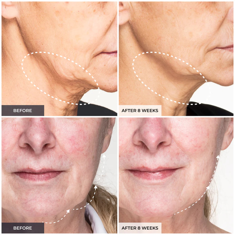 V-Face EMS Facial Lifting Mask | Jawline, Skin Tightening & Wrinkle Reduction