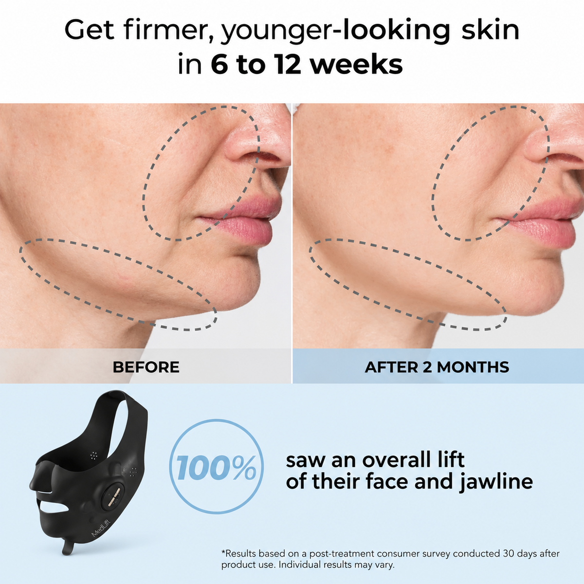 V-Face EMS Facial Lifting Mask | Jawline, Skin Tightening & Wrinkle Reduction